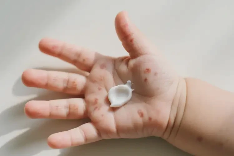 嬰幼兒手上容易起濕疹不管它會(huì)自己好嗎(圖1)