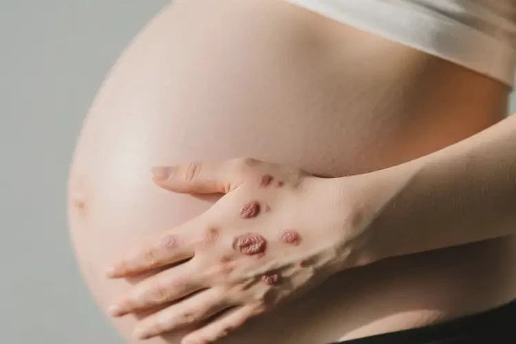 孕婦手上偶爾起濕疹不管它會(huì)自己自愈嗎(圖3)