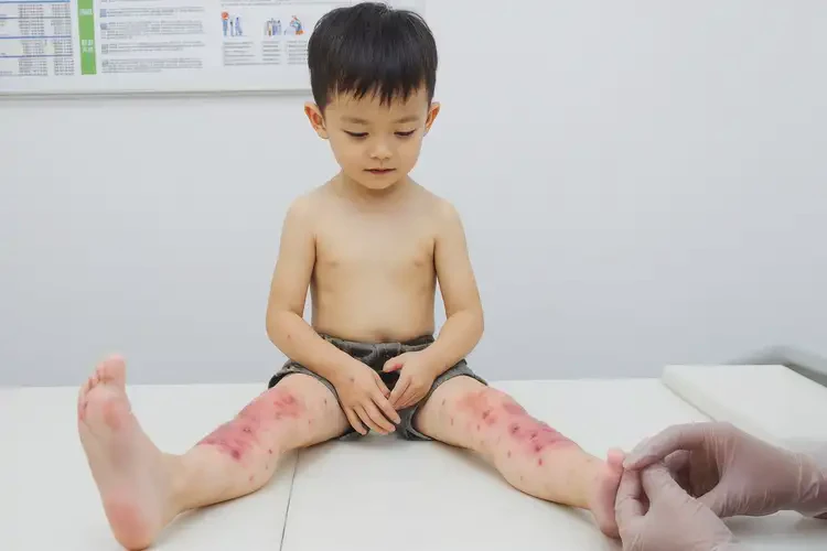 小孩大腿經(jīng)常起濕疹不管它會自己好嗎(圖4)