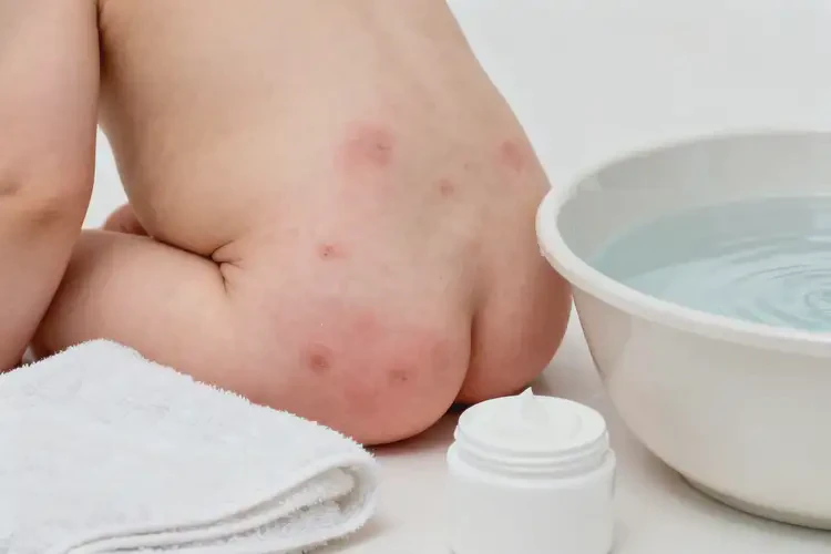 兒童屁股長(zhǎng)濕疹不管它會(huì)自己自愈嗎(圖1)