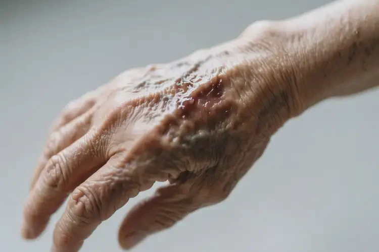 老年人手臂有湿疹不管它会自己好吗(图3)