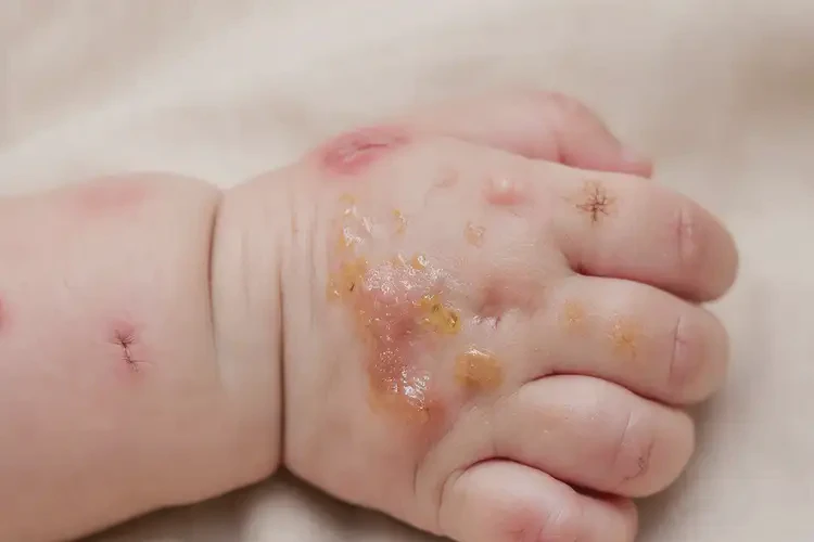 寶寶手上出現(xiàn)濕疹不管它會自己好嗎(圖2)