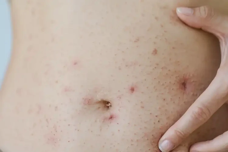 女生肚子出濕疹能靠自己自愈嗎(圖4)