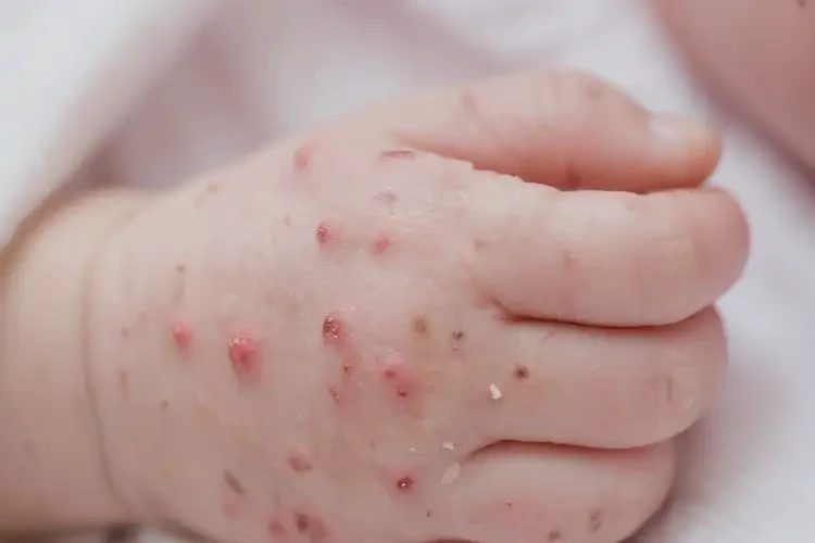 新生兒手上容易起濕疹不管它會(huì)自己好嗎(圖4)