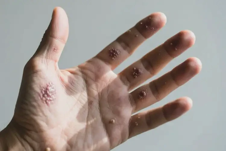 男人手上容易起濕疹可以徹底自愈嗎(圖3)