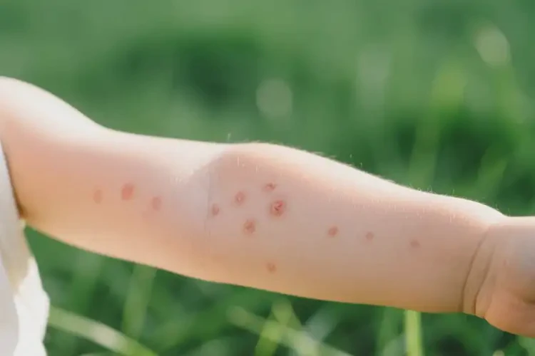 小兒全身偶爾起濕疹能靠自己自愈嗎(圖4)