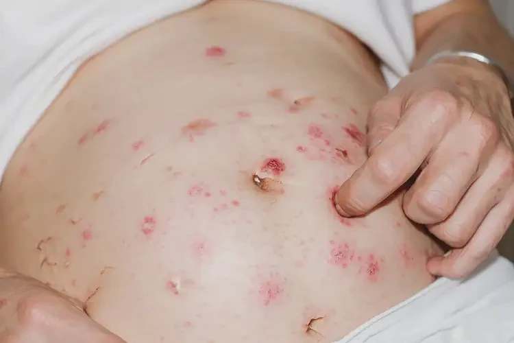 產(chǎn)婦肚子上出濕疹可以徹底自愈嗎(圖4)