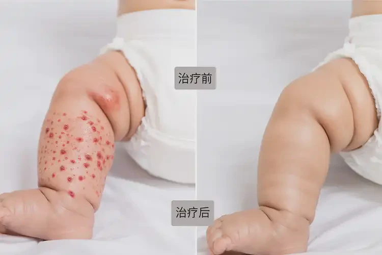嬰兒小腿上長(zhǎng)濕疹能夠徹底治愈嗎(圖1)