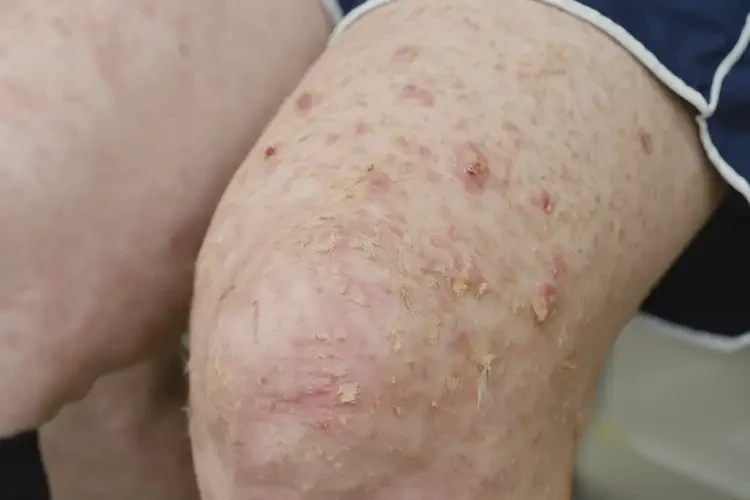 中學生大腿容易起濕疹可以徹底自愈嗎(圖4)