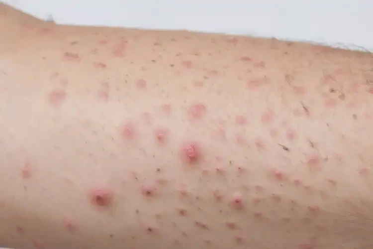 青年人手臂上偶爾起濕疹不管它會(huì)自己痊愈嗎(圖4)