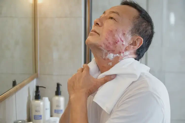 男人脖子偶爾長濕疹能不能徹底自愈(圖3)