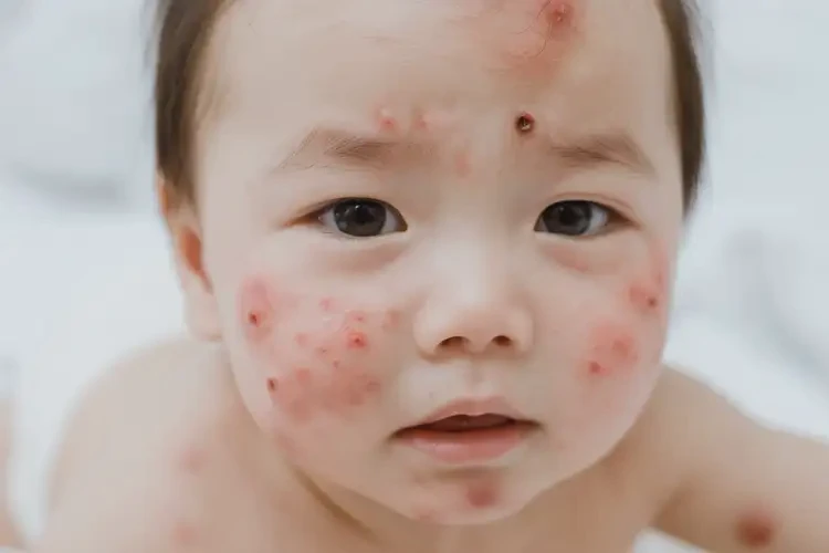 寶寶面部經(jīng)常起濕疹可不可以徹底自愈(圖3)