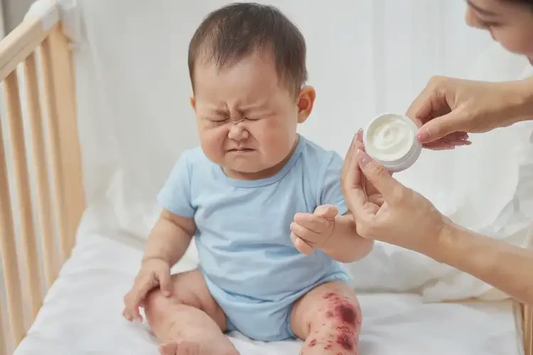 小兒大腿長(zhǎng)濕疹可以徹底自愈嗎(圖3)