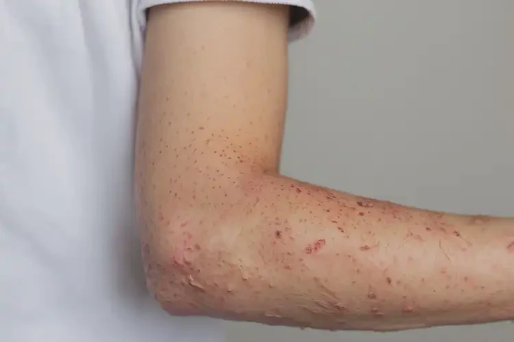 青少年屁股上起濕疹能徹底自愈嗎(圖4)