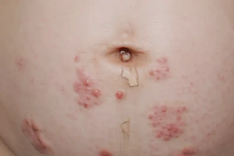 孕婦肛周經(jīng)常長(zhǎng)濕疹能夠徹底治愈嗎(圖4)