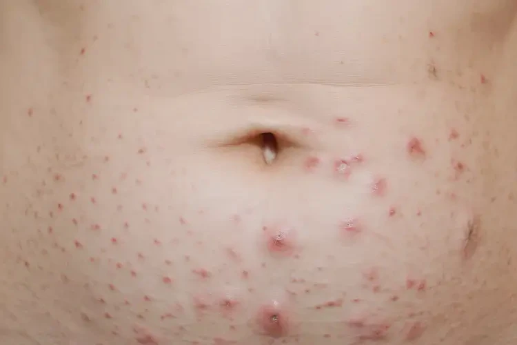 女人肚子上經(jīng)常長(zhǎng)濕疹能夠徹底治愈嗎(圖4)