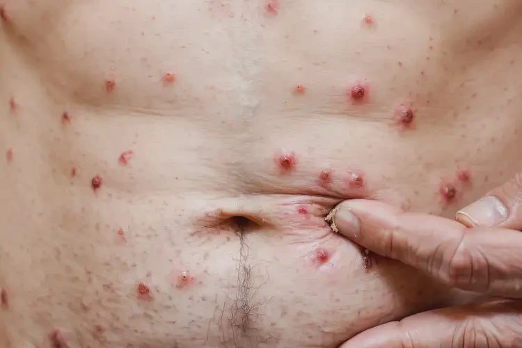 老年人肚子起濕疹不管它會(huì)自己自愈嗎(圖4)