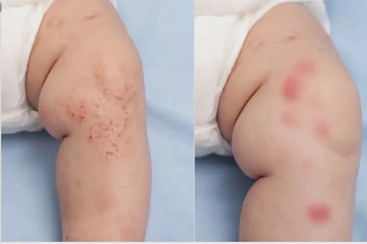 嬰兒小腿容易起濕疹不管它會自己好嗎(圖2)