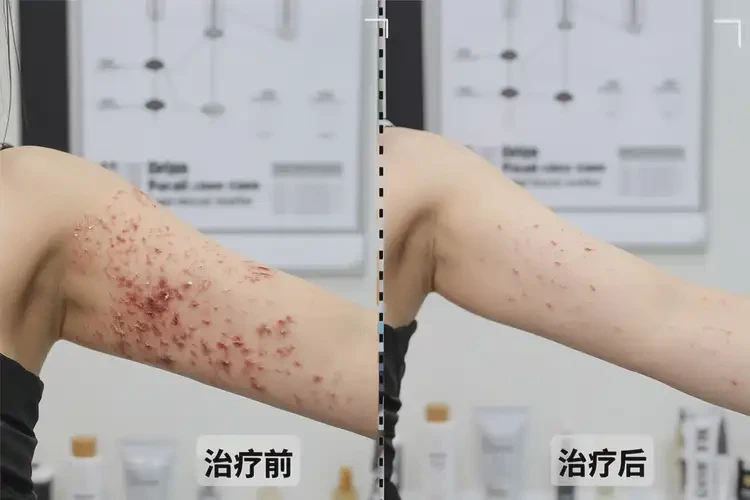 女人屁股起濕疹不管它會自己自愈嗎(圖2)