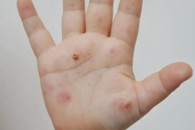 小孩手上長濕疹不管它會(huì)自己好嗎(圖4)