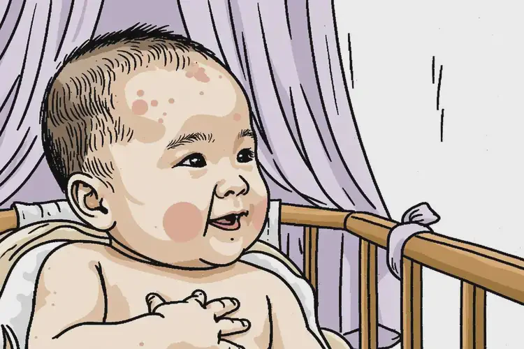 新生儿身上偶尔长湿疹能彻底自愈吗(图1)