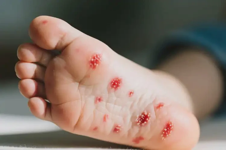 小孩腳上經(jīng)常長濕疹可以徹底自愈嗎(圖4)