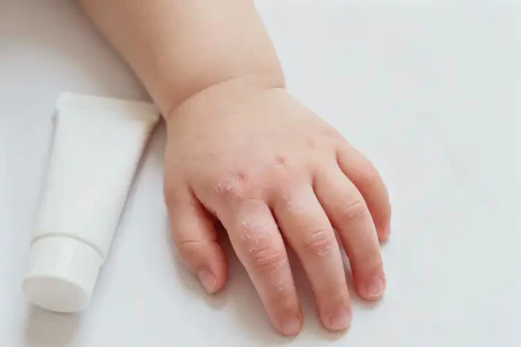 嬰幼兒手上偶爾長濕疹不管它會自己好嗎(圖2)