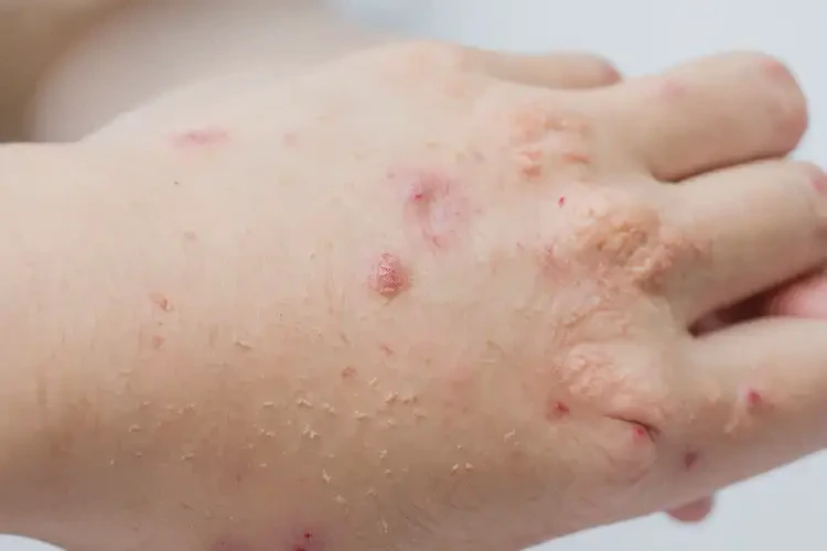 大學(xué)生手上起濕疹不管它會自己自愈嗎(圖4)