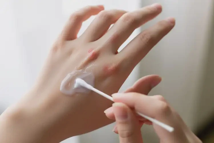 大學(xué)生手上經(jīng)常起濕疹不管它會自己好嗎(圖3)