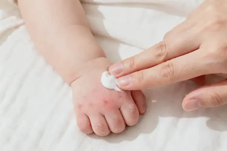 嬰兒手上出濕疹能靠自己自愈嗎(圖2)