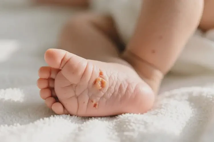 嬰兒腳上偶爾起濕疹能徹底自愈嗎(圖3)