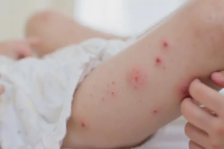 寶寶小腿偶爾起濕疹能靠自己自愈嗎(圖4)