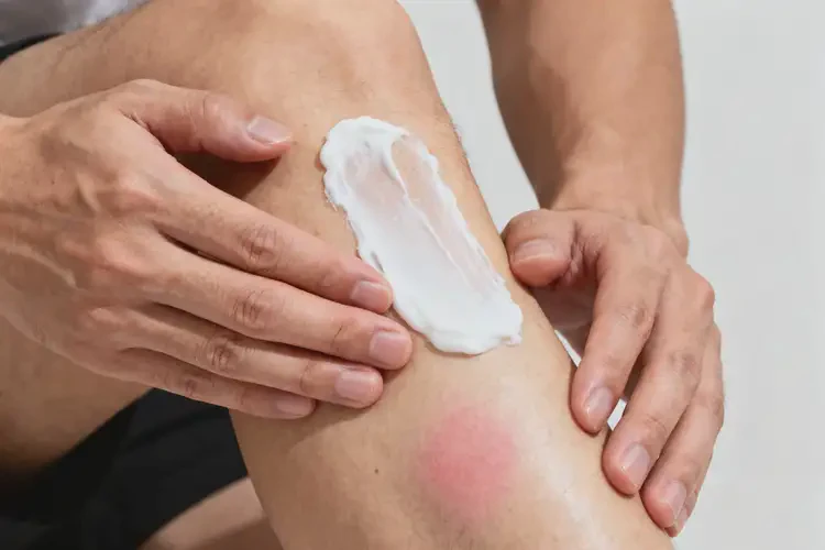 男人小腿偶爾長濕疹不管它會自己好嗎(圖2)