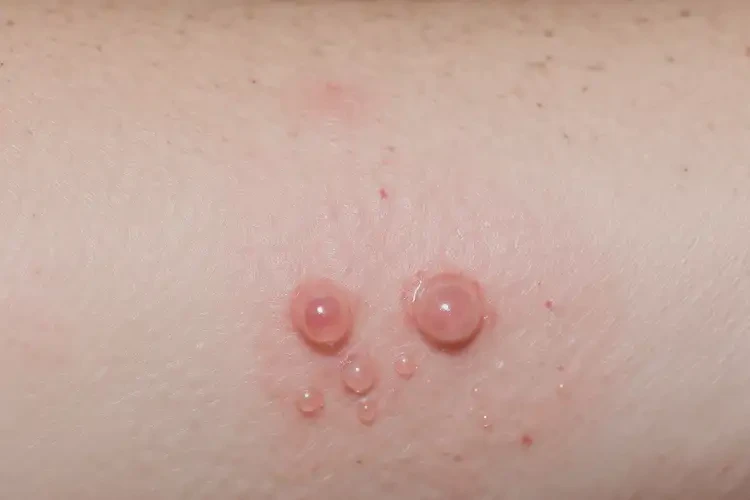 男生肛周經常起濕疹可以徹底自愈嗎(圖4)