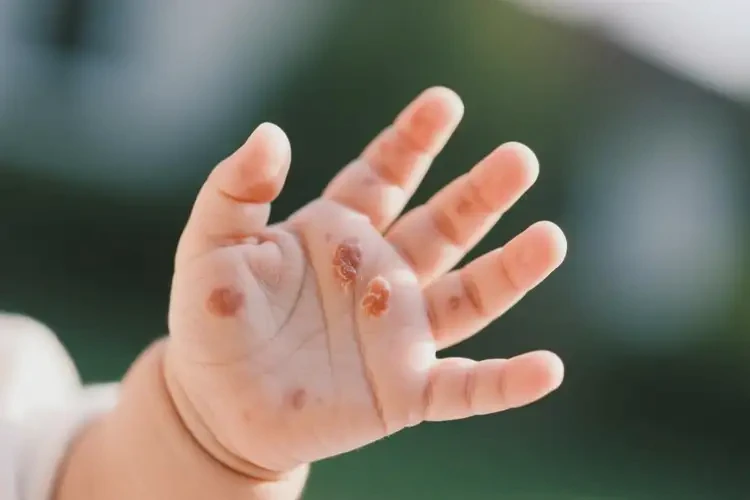 婴幼儿手上出湿疹能靠自己自愈吗(图4)