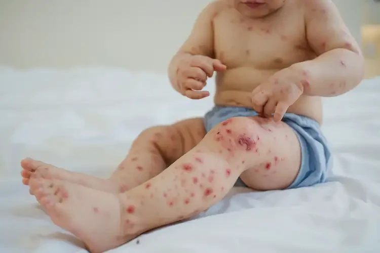 幼兒大腿上經(jīng)常長(zhǎng)濕疹能靠自己自愈嗎(圖4)