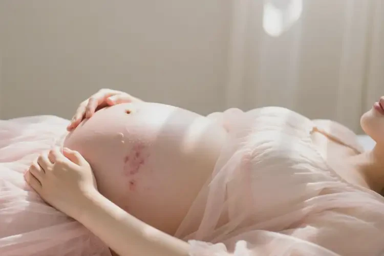 孕婦肚子上偶爾起濕疹可以徹底自愈嗎(圖4)