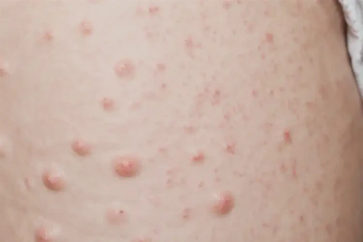 產婦大腿上偶爾起濕疹能徹底自愈嗎(圖4)