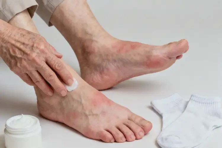 老年人腳上長濕疹能不能徹底自愈(圖1)