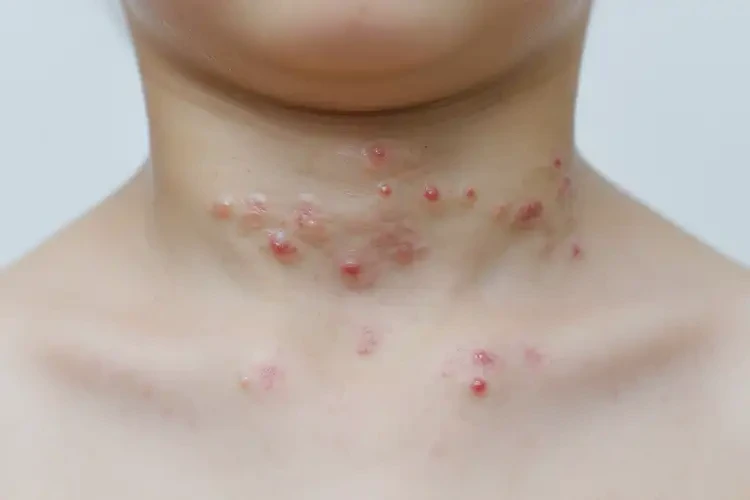 少兒脖子上起濕疹不管它會自己好嗎(圖3)