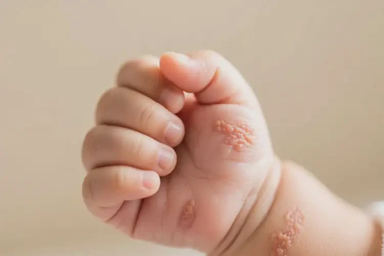 小兒全身容易起濕疹可不可以徹底自愈(圖3)