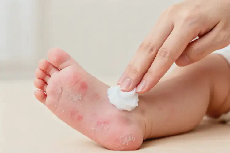 新生兒腳上容易長濕疹能夠徹底治愈嗎(圖3)