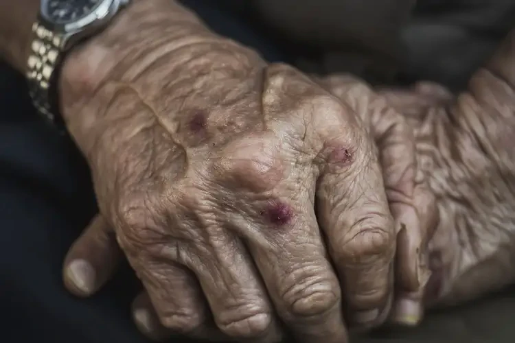 高齡老人全身容易長濕疹能徹底自愈嗎(圖4)