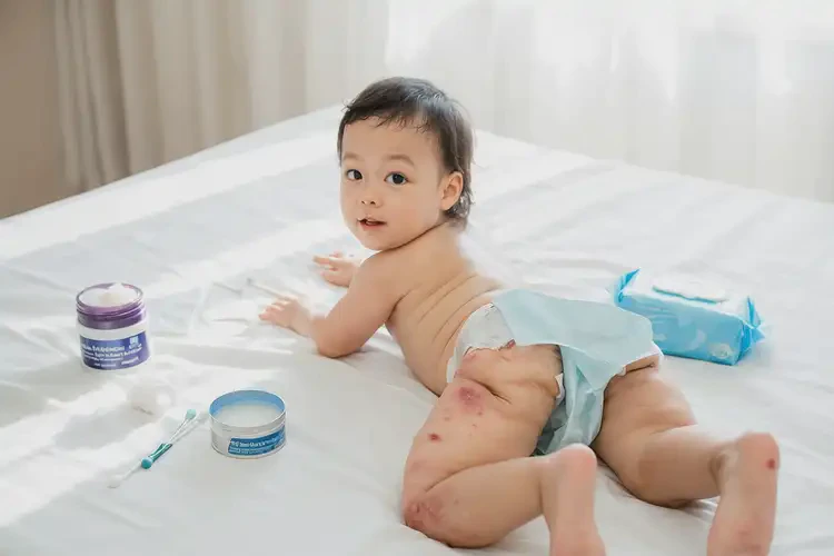 孩子屁股起濕疹可不可以徹底自愈(圖3)