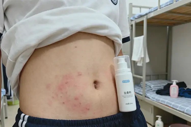 大學生肚子出濕疹能不能徹底自愈(圖3)