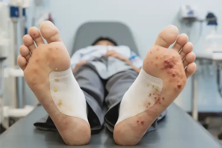 中學(xué)生腳上出濕疹可不可以徹底自愈(圖3)