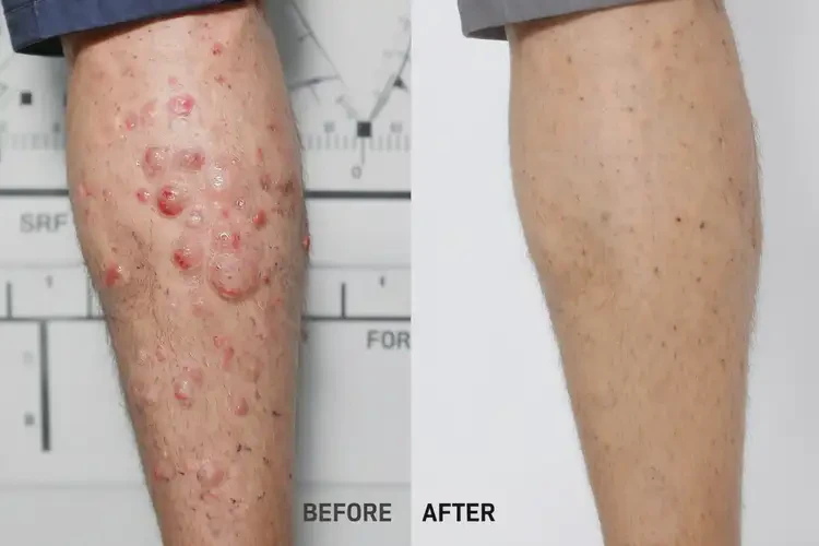 青少年小腿容易長濕疹不管它會自己痊愈嗎(圖1)