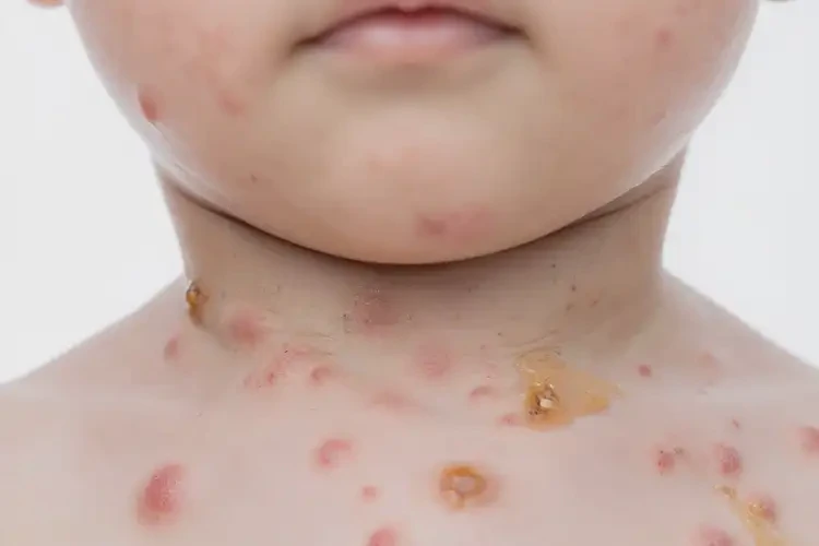 少兒脖子上起濕疹不管它會自己好嗎(圖2)