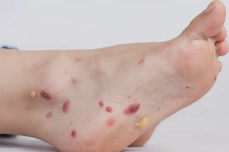 少兒腳上出現(xiàn)濕疹可不可以徹底自愈(圖3)