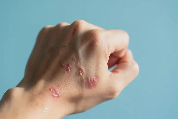 男生手上出濕疹不管它會(huì)自己痊愈嗎(圖2)